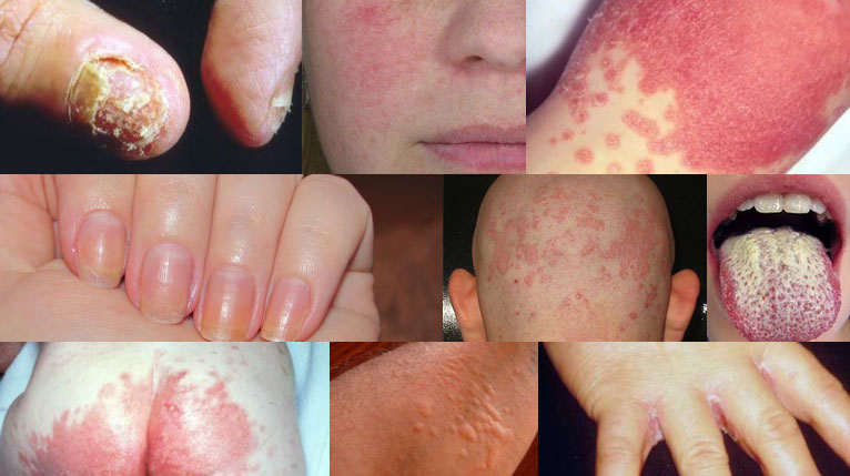 candida priznaky candida priznaky